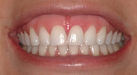 oil pulling for teeth whitening